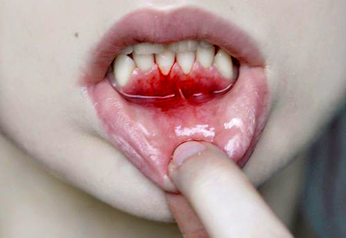copil lovitura dinti