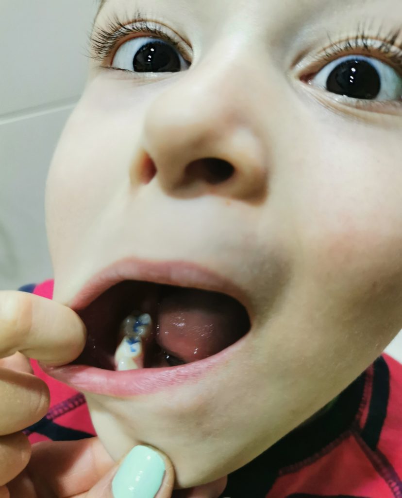 sigilarea dentara la copii, compozit colorat