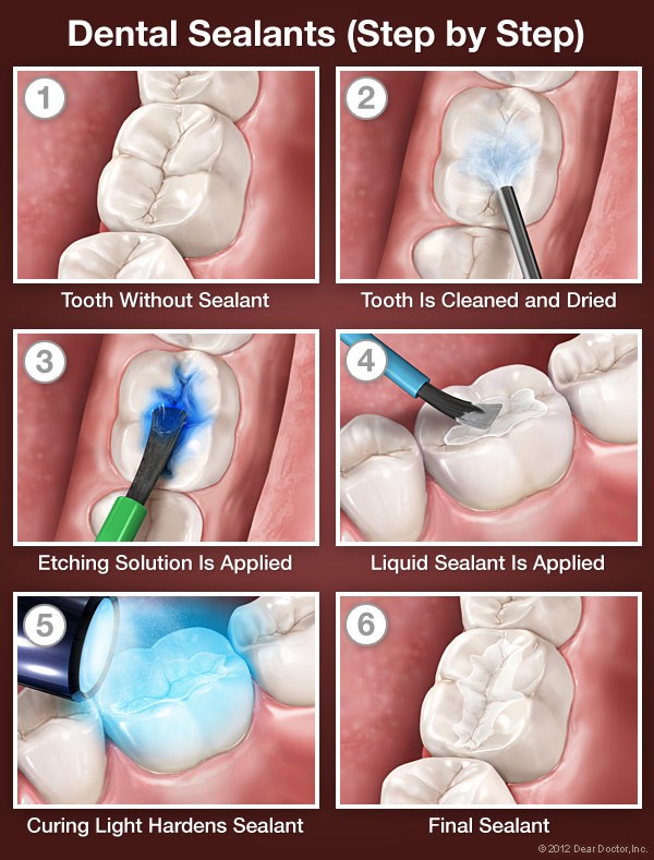 etapele din sigilarea dentara